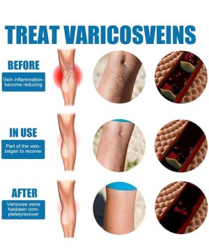 Sprej za proširene vene 88