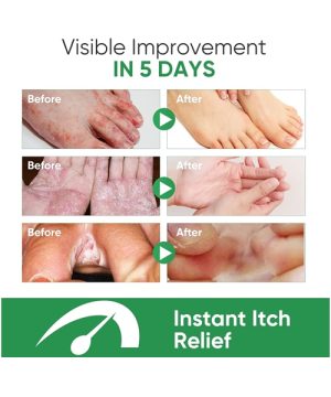 Sprej za stopala protiv gljivica 33